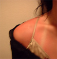 20040720-sunburn02.jpg